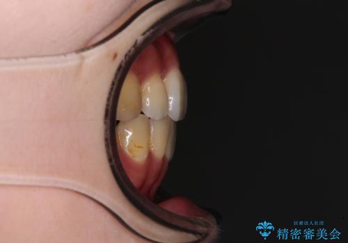 目立たない裏側矯正で突出感を改善 ハーフリンガル矯正の治療後