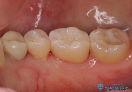 下の歯の銀歯が目立つの治療後