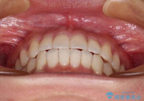 捻れた前歯をできるだけ短期間で　表側のワイヤー矯正の治療後
