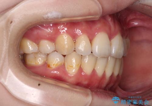 目立たない裏側矯正で突出感を改善 ハーフリンガル矯正の治療後