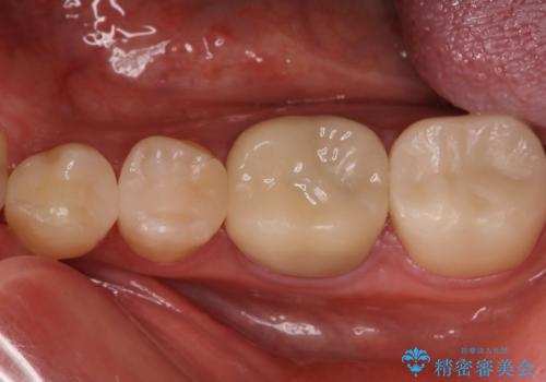 矯正終了し、かけたところをセラミックにて治したい。の症例 治療後