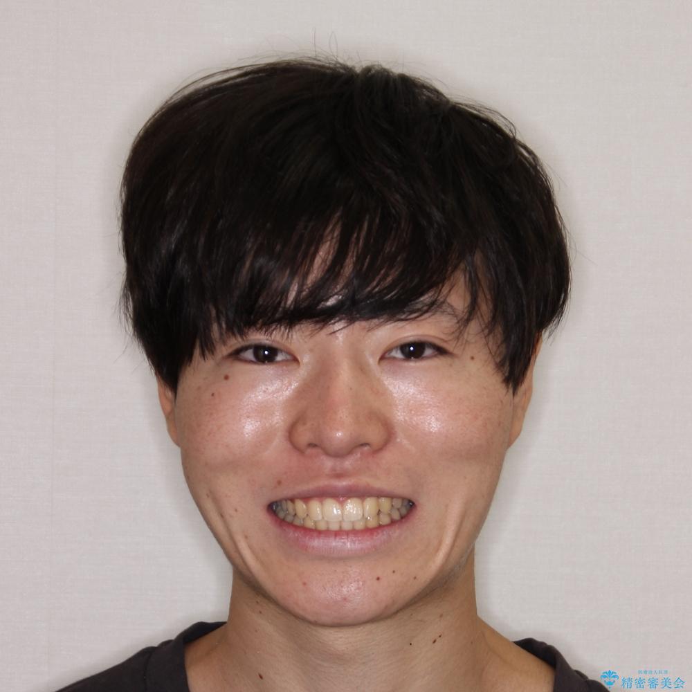 【モニター】斜めに突き出した前歯をインビザラインで改善の治療後(顔貌)