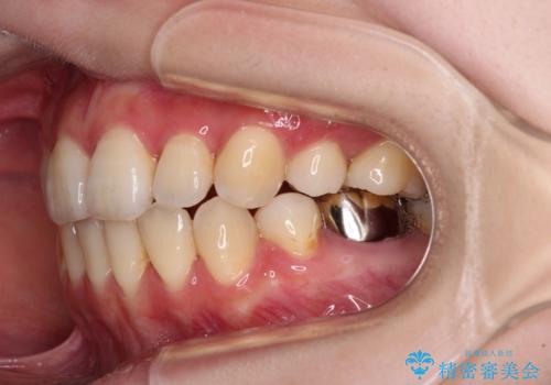 目立たない裏側矯正で突出感を改善 ハーフリンガル矯正の治療後