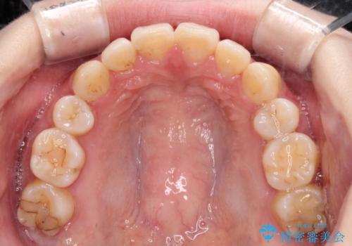 目立たない裏側矯正で突出感を改善 ハーフリンガル矯正の治療後