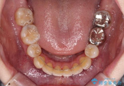目立たない裏側矯正で突出感を改善 ハーフリンガル矯正の治療後