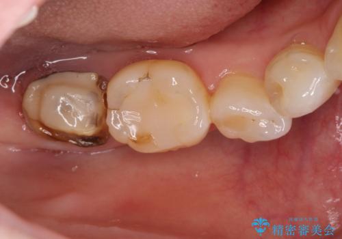 【オールセラミッククラウン】他院で治療した被せものが外れたの症例 治療前