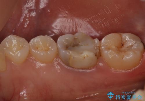 変色した樹脂の詰め物 セラミックでのやり替えの治療前