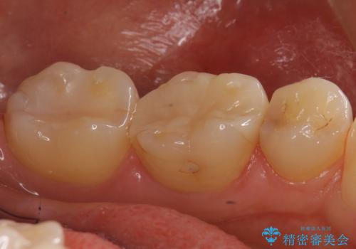 歯と歯の間の虫歯 セラミックインレーでの治療の治療前