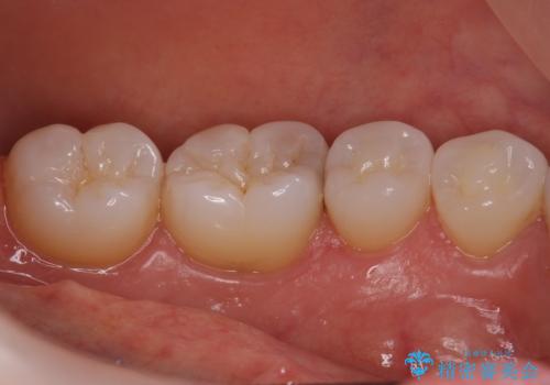 奥歯の虫歯　セラミックインレーでの治療の症例 治療前