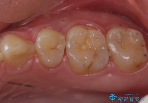 歯と歯の間に隠れた虫歯　セラミックインレーによる治療の症例 治療前