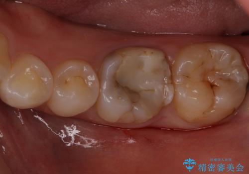 変色した樹脂の詰め物 セラミックでのやり替え