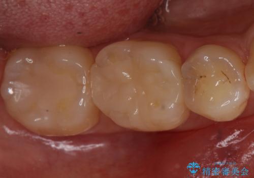 歯と歯の間の虫歯 セラミックインレーでの治療の治療前