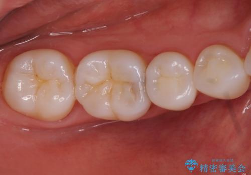奥歯の虫歯 セラミックインレーでの治療の治療前
