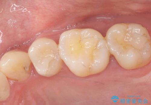 樹脂の詰め物をセラミックで修復の症例 治療前