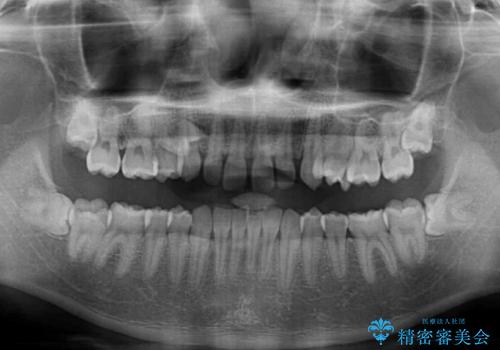 著しいディープバイトと隙間だらけの歯列 の治療前