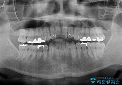 オープンバイトと目立つ銀歯 インビザライン矯正とセラミック修復治療の治療前