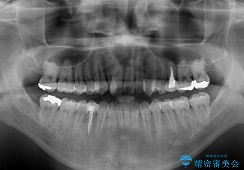 【モニター】左右のクロスバイトをインビザラインできれいに改善の治療前