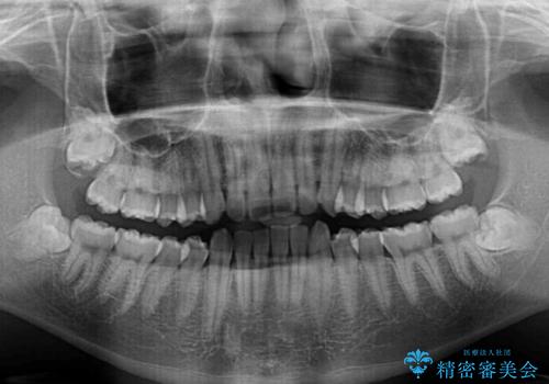 【モニター】斜めに突き出した前歯をインビザラインで改善の治療前