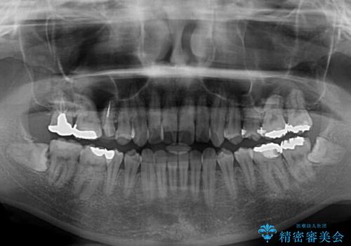 捻れた前歯をインビザラインでスッキリとの治療前