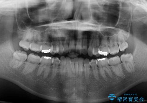インビザライン・ライトで抜歯矯正の後戻りを解消の治療前