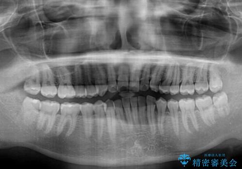 ワイヤー装置での上下前歯の部分矯正の治療前