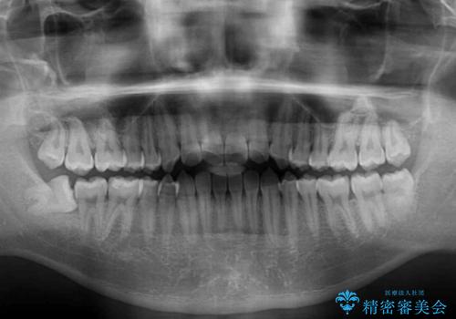 軽微なデコボコを安価に インビザライン・ライトによる矯正治療の治療前