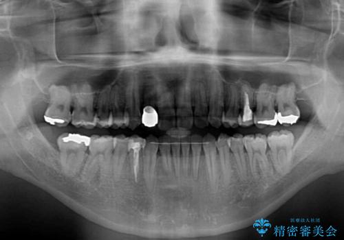 【モニター】左右のクロスバイトをインビザラインできれいに改善の治療後