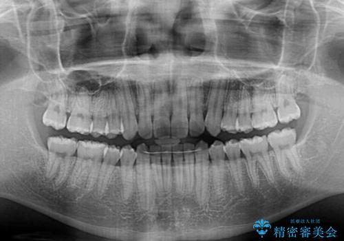 【モニター】斜めに突き出した前歯をインビザラインで改善の治療後