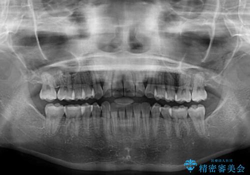 捻れた前歯をできるだけ短期間で　表側のワイヤー矯正の治療後
