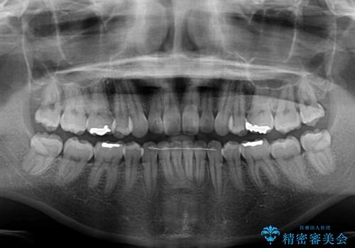 インビザライン・ライトで抜歯矯正の後戻りを解消の治療後