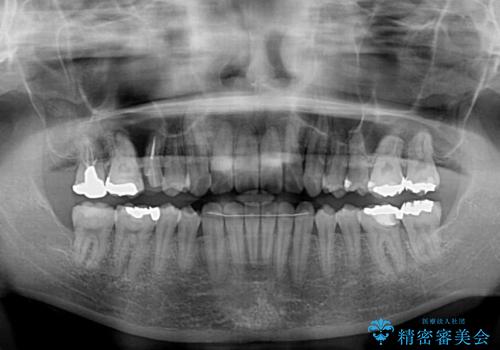 捻れた前歯をインビザラインでスッキリとの治療後