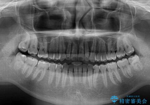 ワイヤー装置での上下前歯の部分矯正の治療後