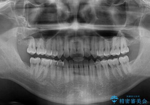軽微なデコボコを安価に インビザライン・ライトによる矯正治療の治療後