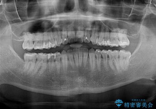 オープンバイトと目立つ銀歯 インビザライン矯正とセラミック修復治療の治療後