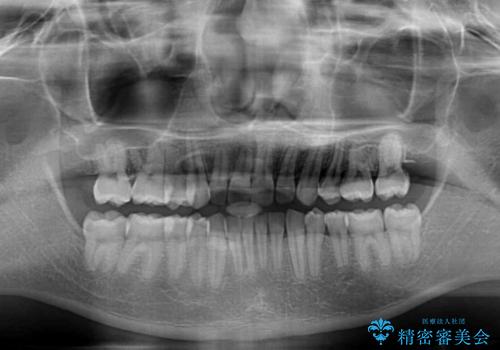 著しいディープバイトと隙間だらけの歯列 の治療後
