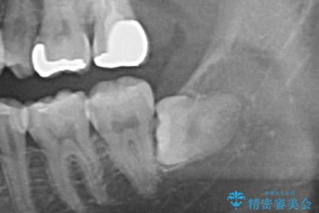 親知らず抜歯の治療前