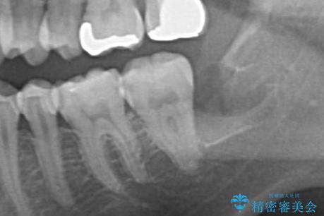 親知らず抜歯の治療後