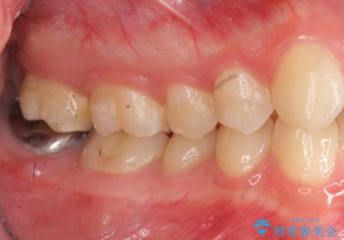 [ 精密根管治療 ]  他院で抜歯しかないと言われた歯を残すの治療前