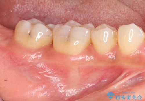 [ 歯周病 ]　歯を残す再生治療の症例 治療前