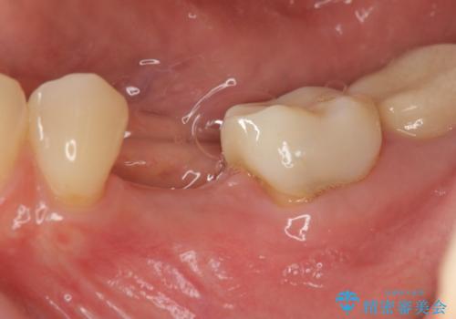 乳歯がぐらついてきた インプラントを用いた機能回復の症例 治療前