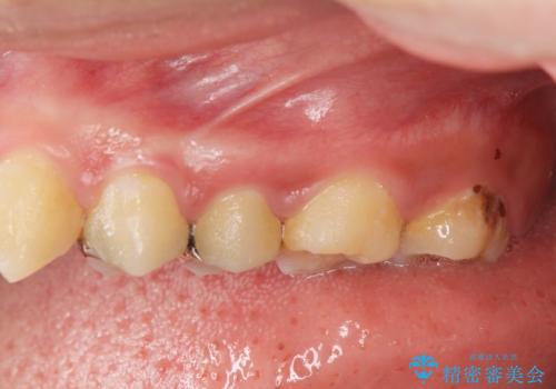 [ 深い虫歯 ]　歯周外科を行い抜歯を回避の症例 治療前
