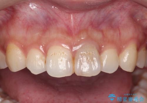 前歯のブリッジ治療の治療前