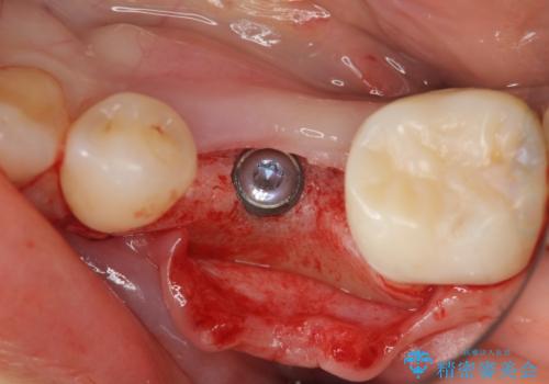 乳歯がぐらついてきた インプラントを用いた機能回復の治療中