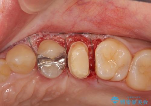 [ 深い虫歯 ]　歯周外科を行い抜歯を回避の治療中