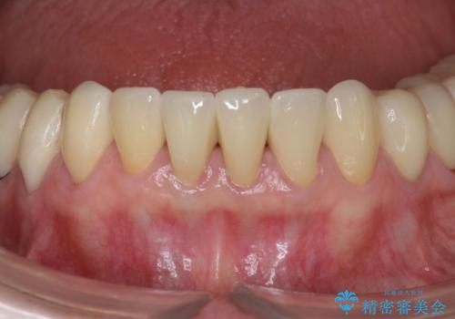 シェーグレン症候群で多発した虫歯　前歯のセラミック治療の症例 治療後