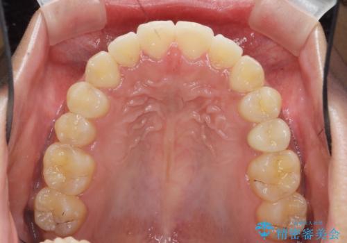 [ マウスピース矯正 ]  前歯の出っ歯感を改善したいの治療後