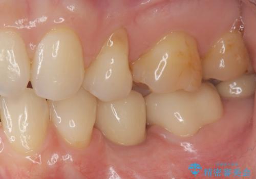 乳歯がぐらついてきた インプラントを用いた機能回復の治療後