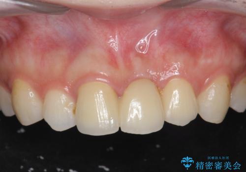 前歯のブリッジ治療の症例 治療後