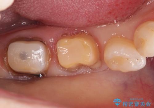【オールセラミッククラウン】他院で治療した被せものが外れたの治療中