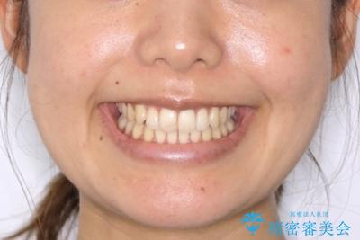 前歯のがたつきを改善してしっかり噛める歯並びへ:インビザライン治療の治療後（顔貌）